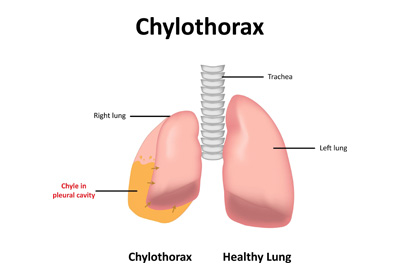 Chylothorax