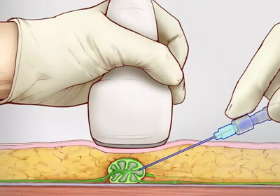 Intranodal Lymphangiography image