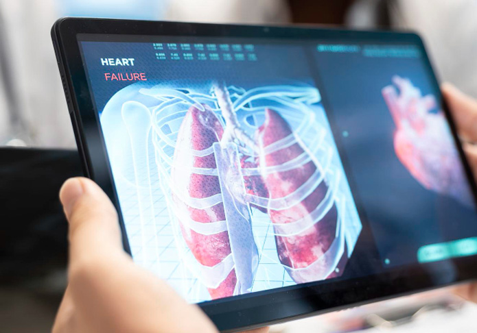 Non traumatic Chylothorax