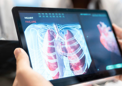 Non traumatic Chylothorax