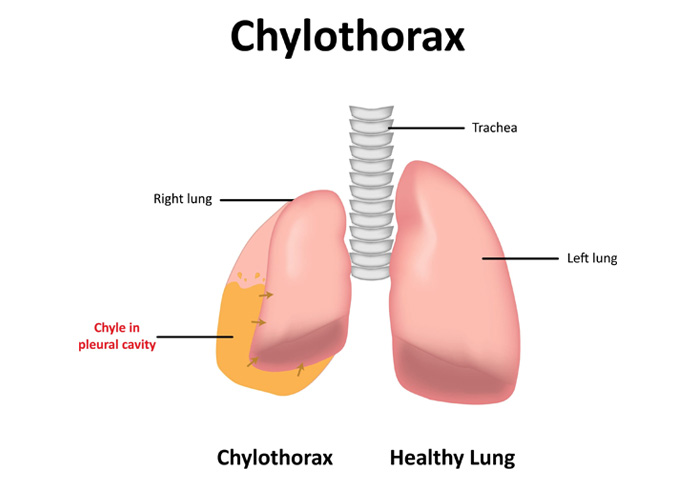 Chylothorax