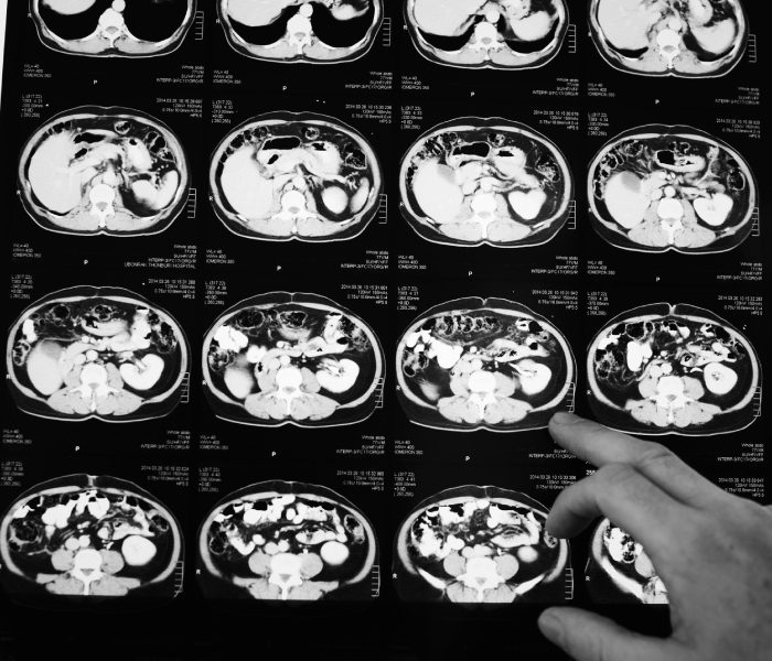 Dynamic Contrast Enhanced MR Lymphangiography